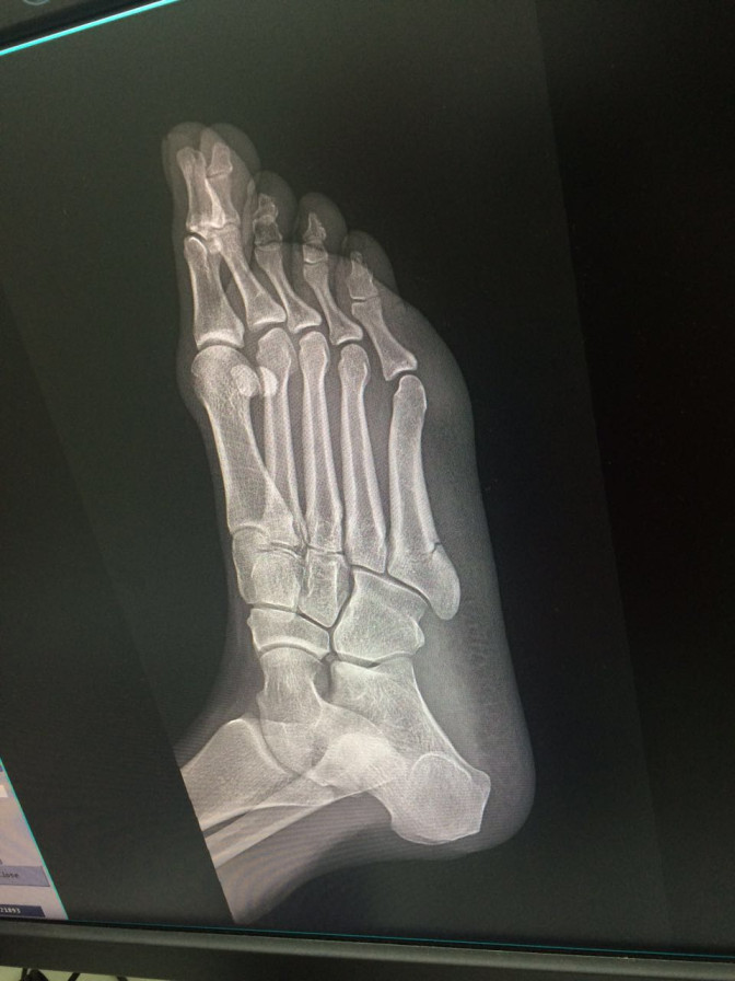 Fractura-3.jpeg